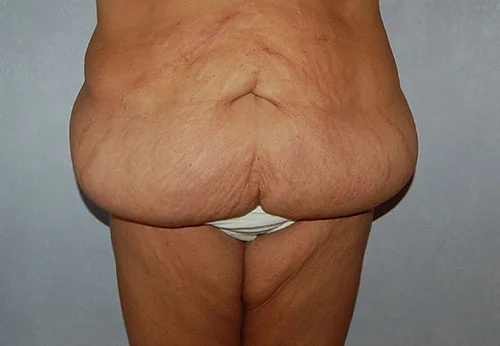 Abdominoplasty (Tummy Tuck), Cincinnati & Springboro