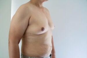 Are My Male Breasts Fat or Gynecomastia?