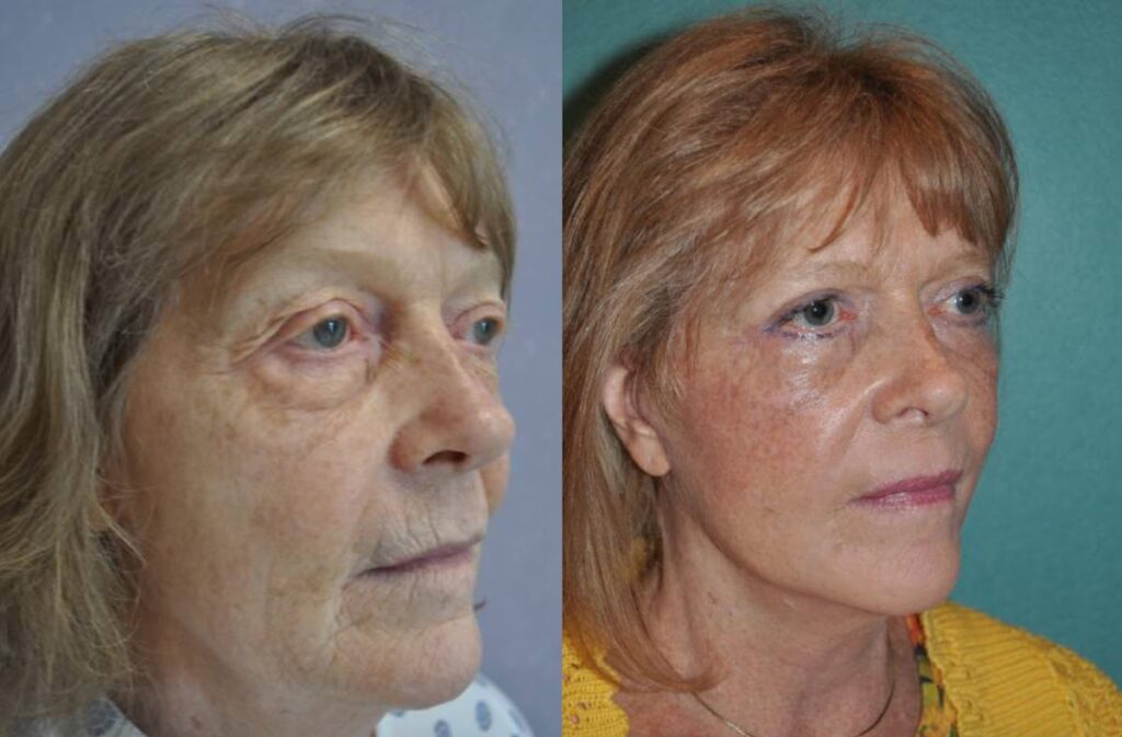 Side view of facelift patient shown before and after facelift with eyelid lift at Mandell-Brown Plastic Surgery Center in Cincinnati