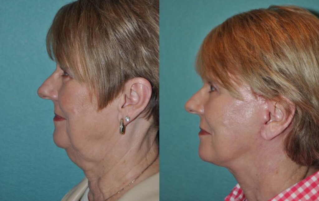 Side view of facelift patient shown before and after facelift with neck lift at Mandell-Brown Plastic Surgery Center in Cincinnati