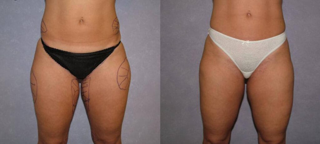 Before and after liposuction to the hips and inner thigh with Dr. Mandell Brown in Ohio