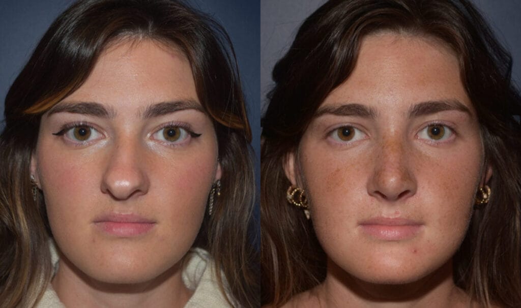 Female patient shown front view before and after nose reshaping surgery with Dr. Mandell-Brown in Ohio