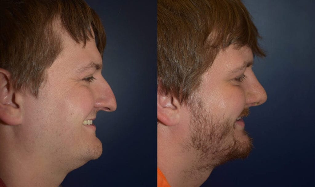 Male patient shown from the side before and after rhinoplasty with Dr. Mark Mandell-Brown in Ohio