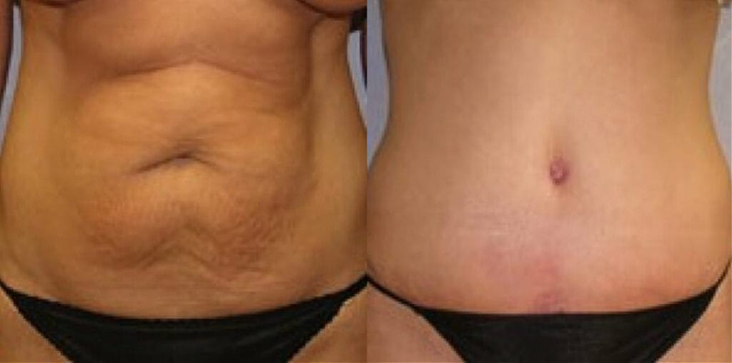 Before and after a tummy tuck with Cincinnati 