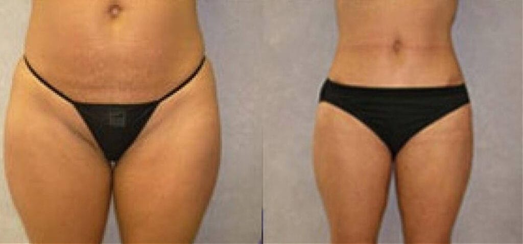 Before and after tummy tuck with Cincinnati cosmetic surgeon Dr. Mandell-Brown