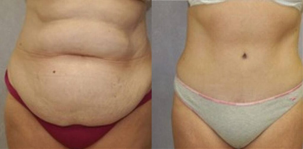 Before and after tummy tuck with Cincinnati cosmetic surgeon Dr. Mandell-Brown