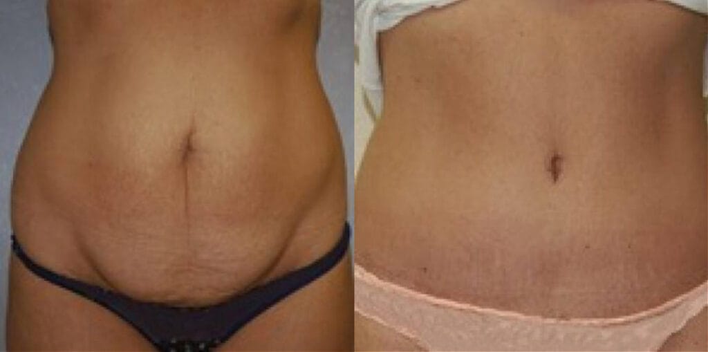 Before and after tummy tuck with Cincinnati cosmetic surgeon Dr. Mandell-Brown